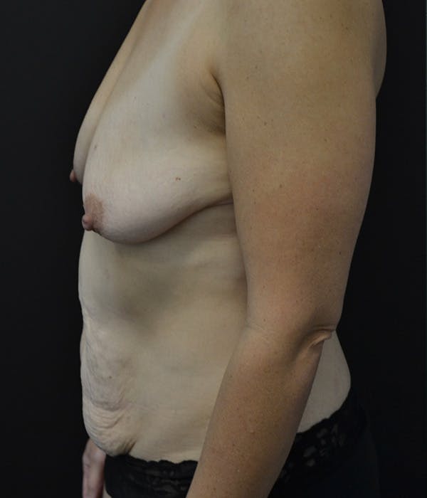 Tummy Tuck Before & After Gallery - Patient 146622657 - Image 9
