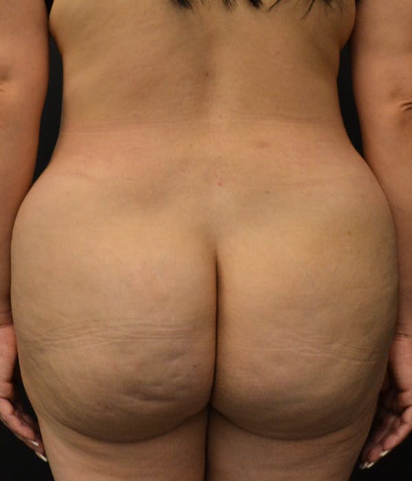 Liposuction & SmartLipo Before & After Gallery - Patient 146622581 - Image 10