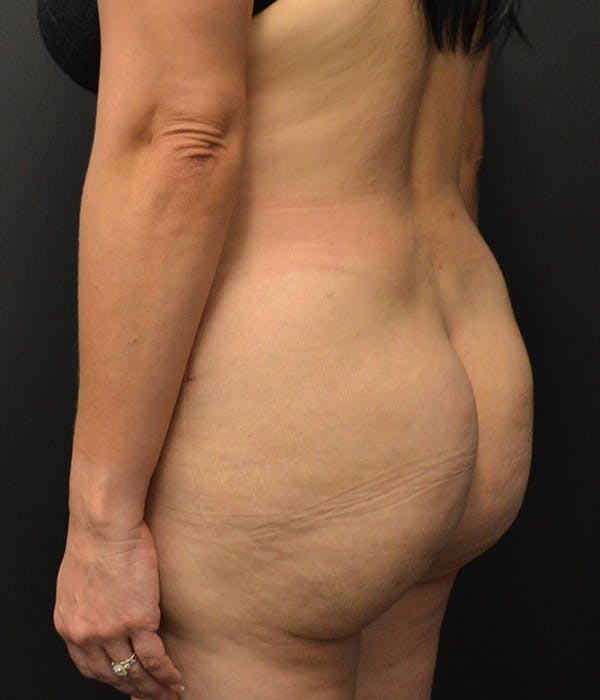 Tummy Tuck Before & After Gallery - Patient 146622580 - Image 12