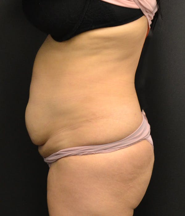 Tummy Tuck Before & After Gallery - Patient 146622580 - Image 13