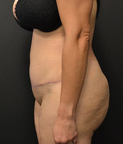 Tummy Tuck Before & After Gallery - Patient 146622580 - Image 14