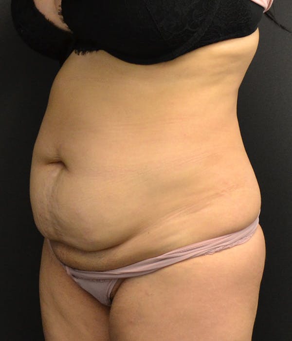 Tummy Tuck Before & After Gallery - Patient 146622580 - Image 15