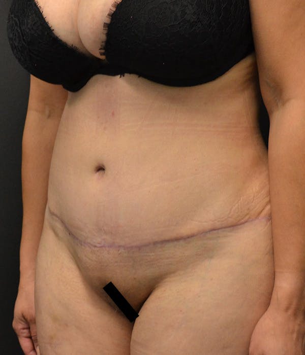 Tummy Tuck Before & After Gallery - Patient 146622580 - Image 16
