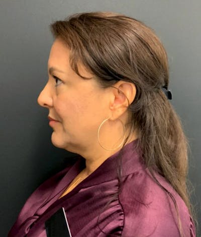 Neck Lift Before & After Gallery - Patient 147741096 - Image 1