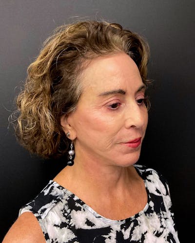 Facelift Before & After Gallery - Patient 147741110 - Image 2