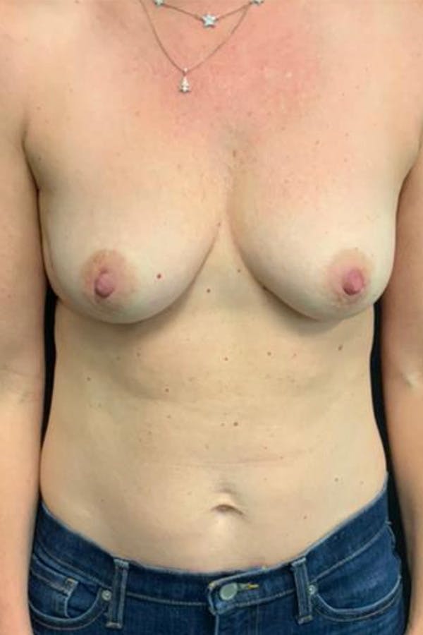 Breast Augmentation Before & After Gallery - Patient 23533118 - Image 1