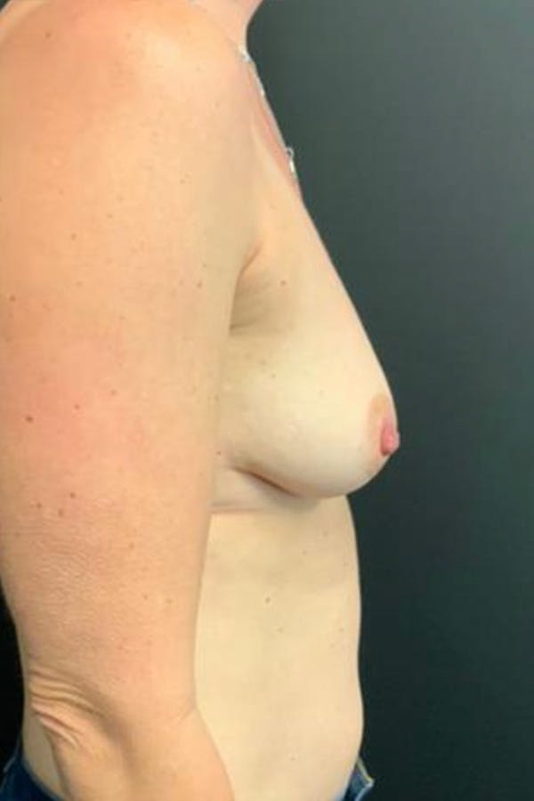 Breast Augmentation Before & After Gallery - Patient 23533118 - Image 5