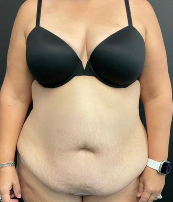 Tummy Tuck Before & After Gallery - Patient 148148498 - Image 1