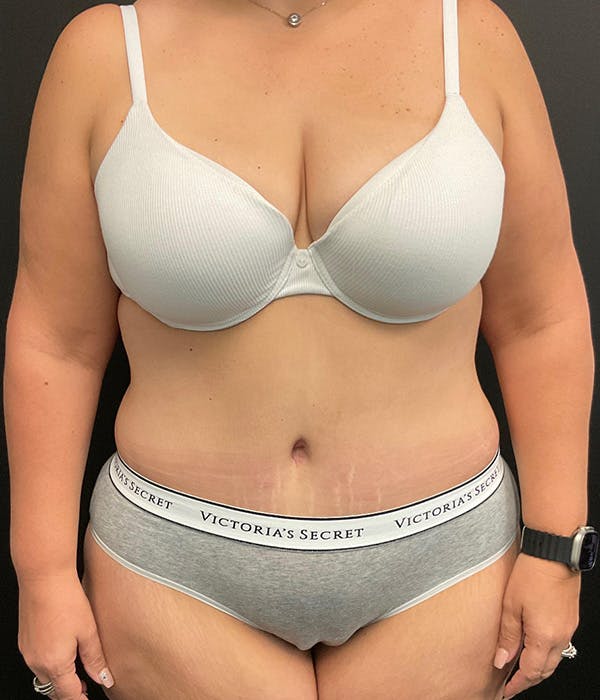 Tummy Tuck Before & After Gallery - Patient 148148498 - Image 2