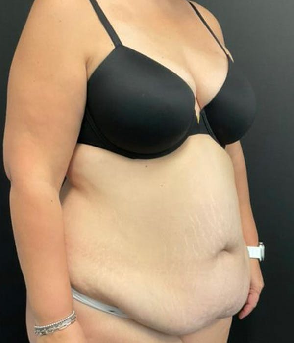 Tummy Tuck Before & After Gallery - Patient 148148498 - Image 3