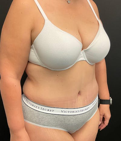 Tummy Tuck Before & After Gallery - Patient 148148498 - Image 4