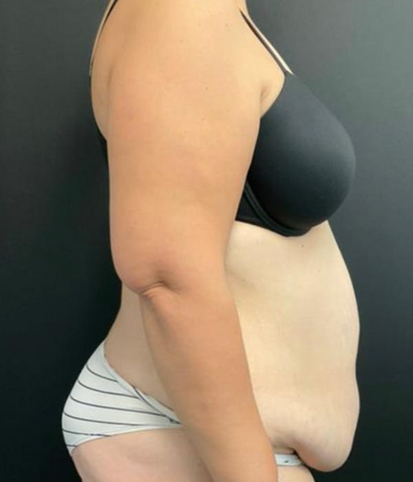 Tummy Tuck Before & After Gallery - Patient 148148498 - Image 5