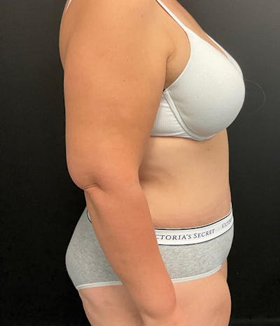 Tummy Tuck Before & After Gallery - Patient 148148498 - Image 6