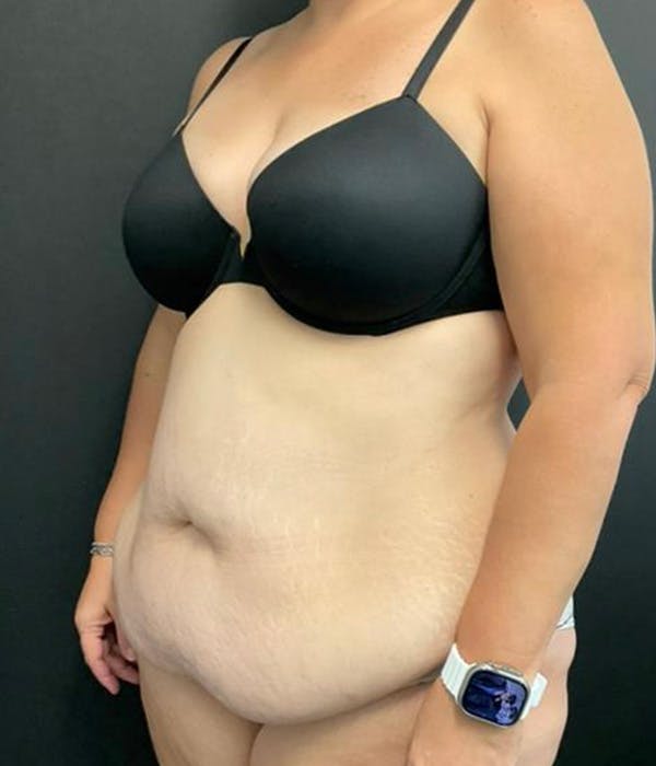 Tummy Tuck Before & After Gallery - Patient 148148498 - Image 7