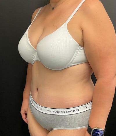 Tummy Tuck Before & After Gallery - Patient 148148498 - Image 8