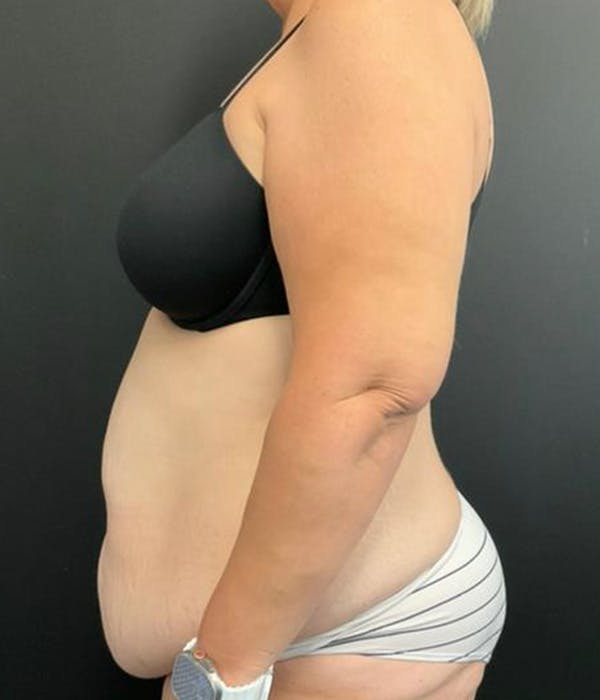 Tummy Tuck Before & After Gallery - Patient 148148498 - Image 9