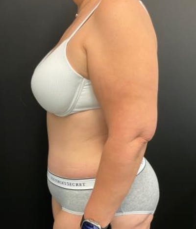Tummy Tuck Before & After Gallery - Patient 148148498 - Image 10