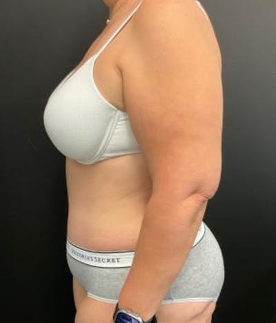 Tummy Tuck Before & After Gallery - Patient 148148498 - Image 10