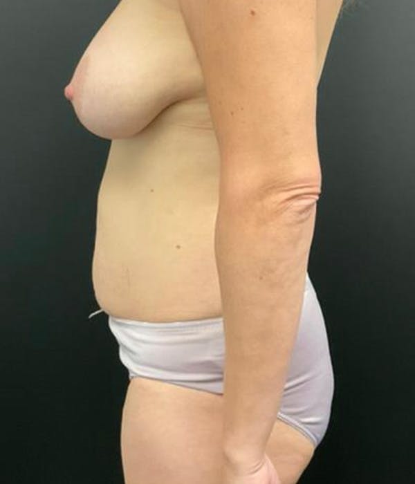 Tummy Tuck Before & After Gallery - Patient 148148499 - Image 9