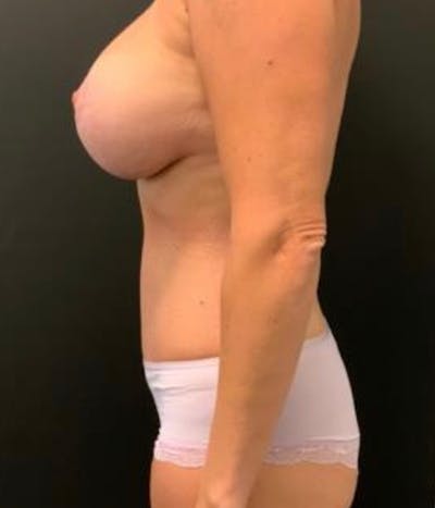 Tummy Tuck Before & After Gallery - Patient 148148499 - Image 10