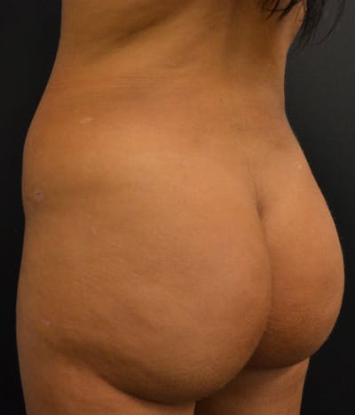 Fat Grafting Before & After Gallery - Patient 148148500 - Image 2