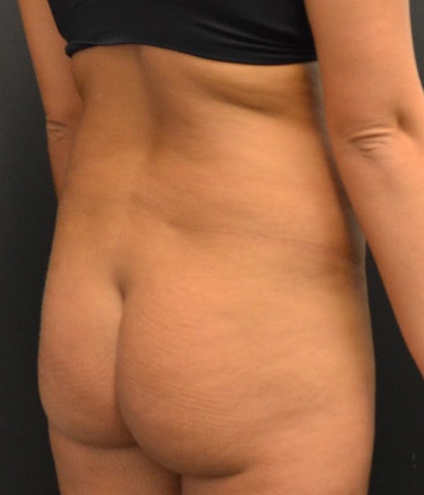 Fat Grafting Before & After Gallery - Patient 148148500 - Image 3