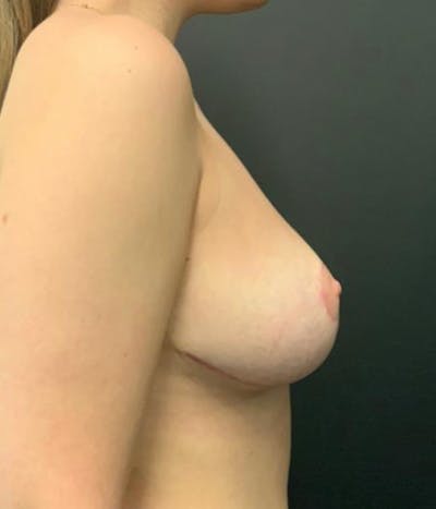 Breast Reduction Before & After Gallery - Patient 148148507 - Image 6