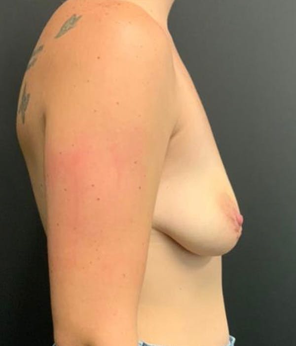 Breast Augmentation Before & After Gallery - Patient 148190709 - Image 5