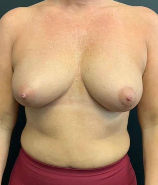 Breast Augmentation Before & After Gallery - Patient 148190708 - Image 1