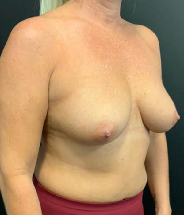 Breast Augmentation Before & After Gallery - Patient 148190708 - Image 3