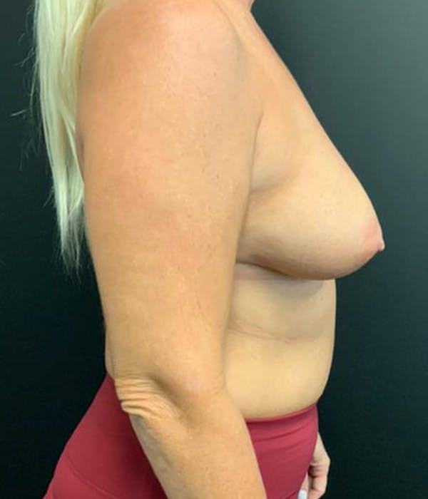 Breast Augmentation Before & After Gallery - Patient 148190708 - Image 5