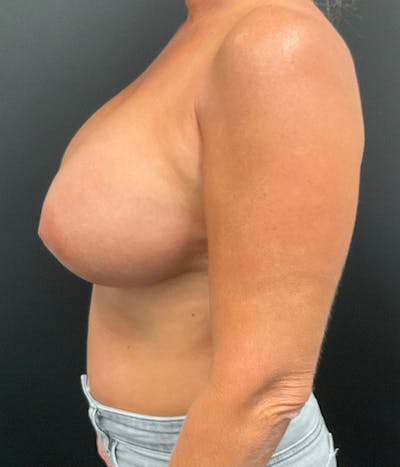 Breast Augmentation Before & After Gallery - Patient 148190708 - Image 10