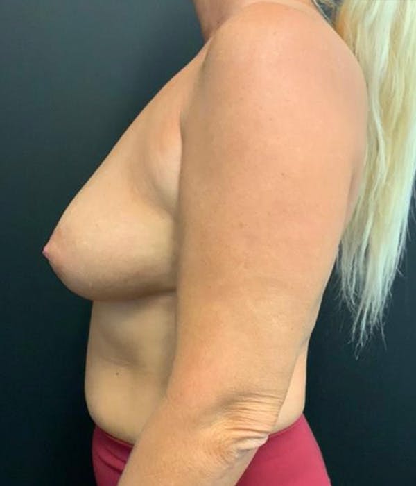 Breast Augmentation Before & After Gallery - Patient 148190708 - Image 9