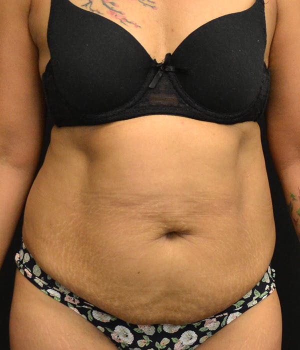 Tummy Tuck Before & After Gallery - Patient 148190713 - Image 1