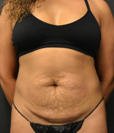 Tummy Tuck Before & After Gallery - Patient 148190712 - Image 1