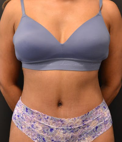 Tummy Tuck Before & After Gallery - Patient 148190712 - Image 2