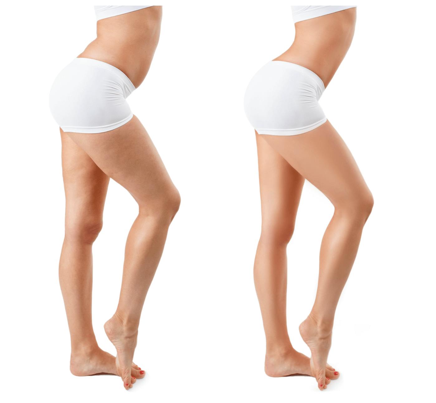 Image related to an article discussing Dr. Garramone’s favorite treatment for body contouring and skin tightening