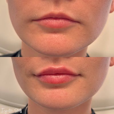 Lip Fillers Before & After Gallery - Patient 339986 - Image 1