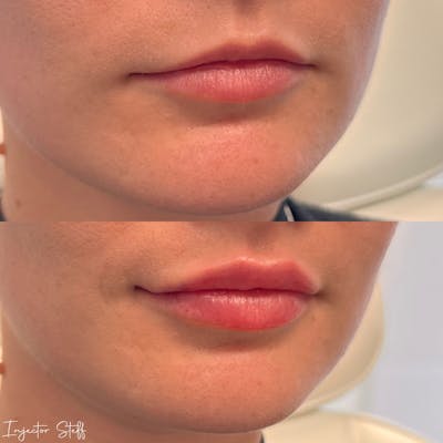 Lip Fillers Before & After Gallery - Patient 339986 - Image 2