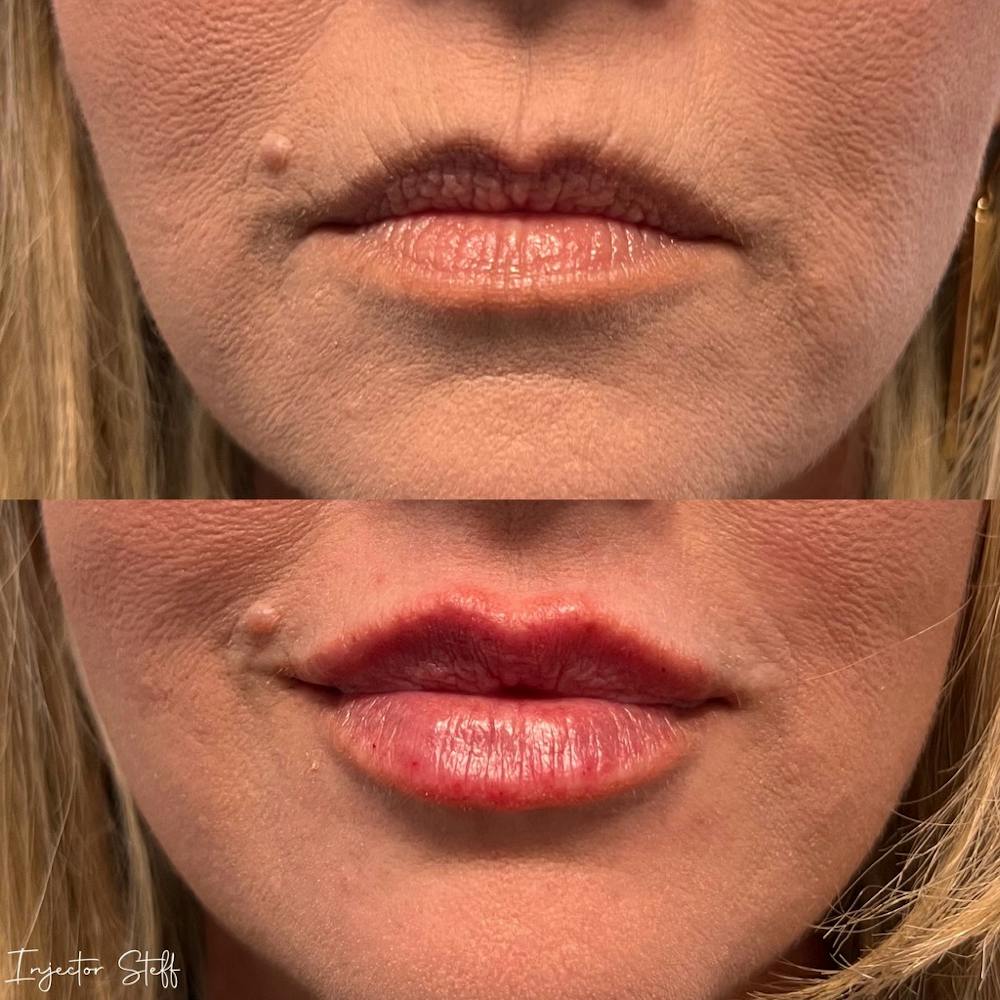 Lip Fillers Before & After Gallery - Patient 297104 - Image 1