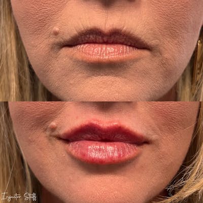 Lip Fillers Before & After Gallery - Patient 297104 - Image 1