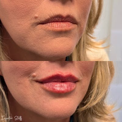 Lip Fillers Before & After Gallery - Patient 297104 - Image 2