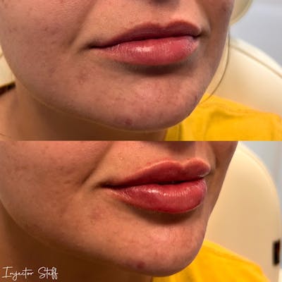 Lip Fillers Before & After Gallery - Patient 330254 - Image 2