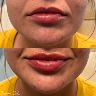 Lip Fillers Before & After Gallery - Patient 330254 - Image 1