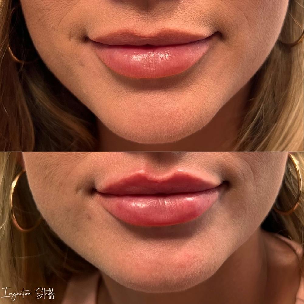 Lip Fillers Before & After Gallery - Patient 185865 - Image 1