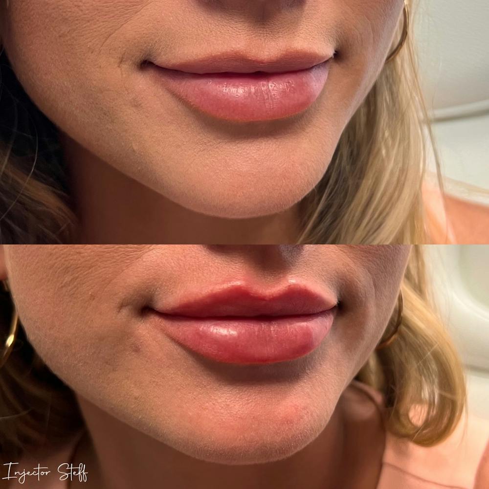 Lip Fillers Before & After Gallery - Patient 185865 - Image 2