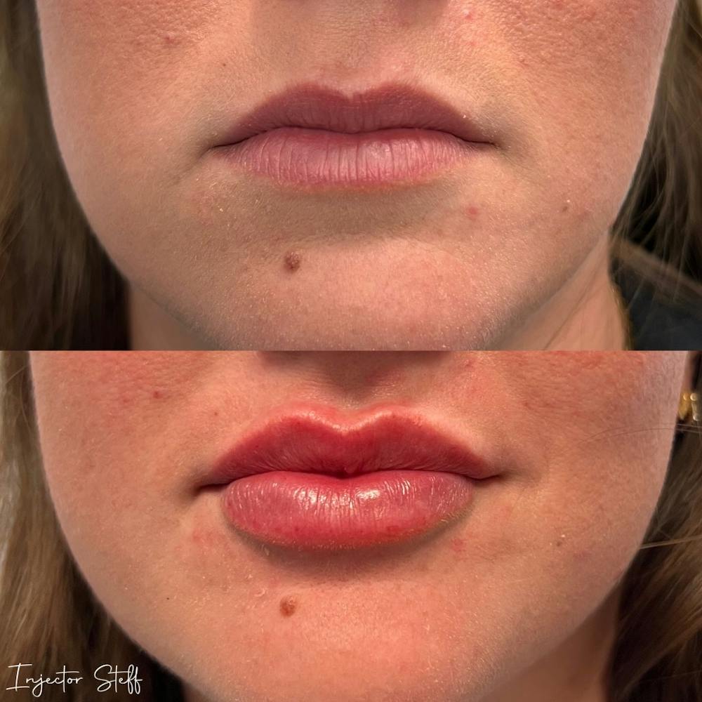 Lip Fillers Before & After Gallery - Patient 410346 - Image 1