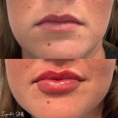 Lip Fillers Before & After Gallery - Patient 410346 - Image 1