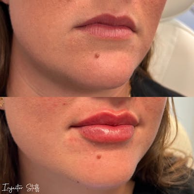 Lip Fillers Before & After Gallery - Patient 410346 - Image 2