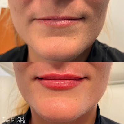 Lip Fillers Before & After Gallery - Patient 223887 - Image 1